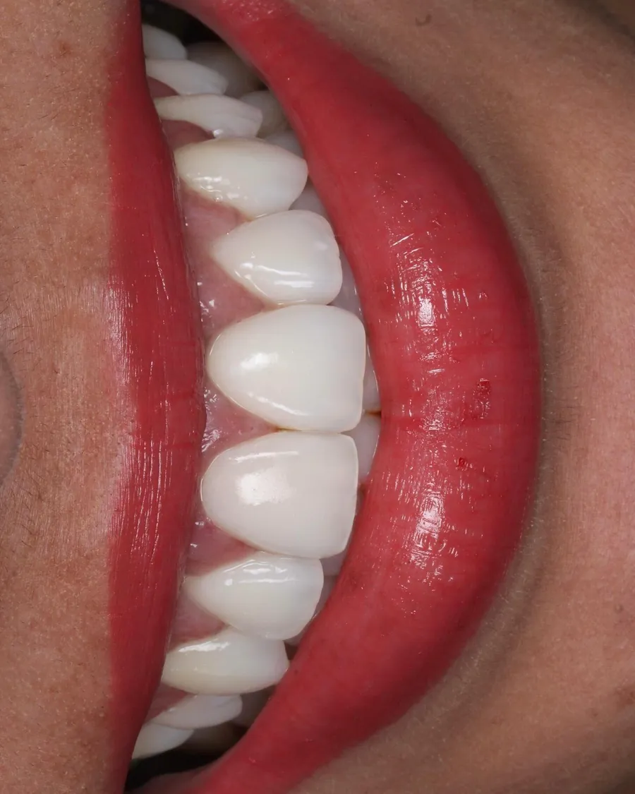 Close de um sorriso com dentes claros e alinhados